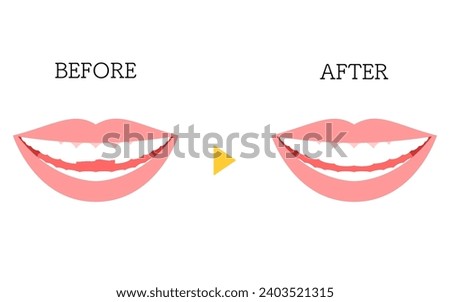 Cosmetic dentistry, direct bonding before and after, chipped tooth, Vector Illustration