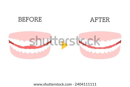 Cosmetic dentistry, direct bonding before and after, chipped tooth, Vector Illustration
