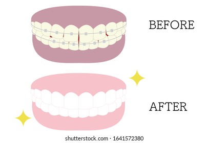 Cosmetic dentistry, orthodontic illustrations: distorted and beautiful tooth alignment, from yellowing and gingival pigmentation to white teeth