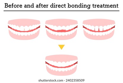 Cosmetic dentistry: treatment with direct bonding, decayed or chipped teeth, and gaps, Vector Illustration