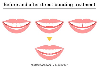 Cosmetic dentistry: treatment with direct bonding, decayed or chipped teeth, and gaps, Vector Illustration