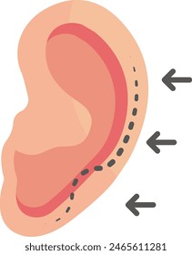 cosmetic ear surgery or Macrotia concept, ears outer cartilage remodeling vector flat design, plastic surgeon Symbol, body contouring Sign, Beauty treatment stock illustration
