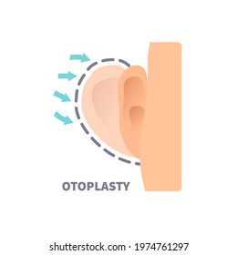 Cosmetic facial plastic ear surgery for men. Before and after otoplasty surgical correction procedure. Pinnaplasty ear pinning reshaping design template. Medical vector illustration.