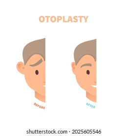 Cosmetic facial plastic ear surgery for men. Before and after otoplasty surgical correction procedure. Pinnaplasty ear pinning reshaping design template. Medical vector illustration.