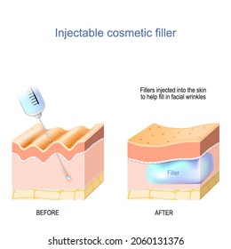 relleno cosmético inyectable. Piel con arrugas antes de la inyección de ácido hialurónico y capas de piel después del procedimiento médico. tratamiento antiedad. Láminas inyectadas para ayudar a llenar las arrugas faciales 