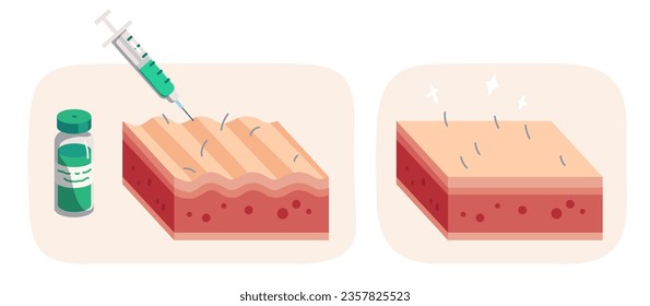 Tratamiento cutáneo para inyección cosmética. Jeringa inyectar colágeno en la capa de piel, antes y después del tratamiento con arrugas. Cosmetología de belleza facial, concepto de medicina de rejuvenecimiento mesoterapéutico ilustración vectorial plana