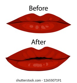 Cosmetic procedure lips augmentation. before and after.Attractive female mouth.Isolated on white background