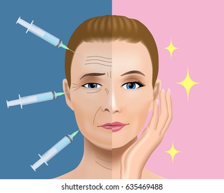 Cosmetic surgery concept. Botox injection. woman facial wrinkle treatment.