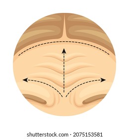 Cosmetic surgery on female forehead with dotted lines. Plastic surgery vector illustration