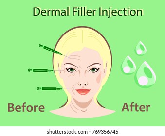 Cosmetic surgery vector illustration. Dermal filler injection. woman facial wrinkle treatment.