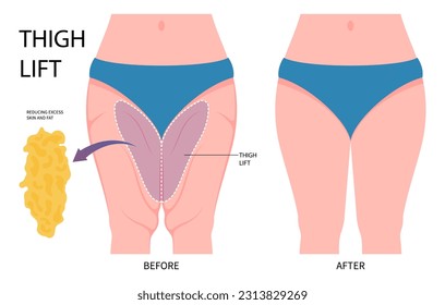 Liposucción del procedimiento para eliminar el tejido graso del muslo y remodelar la pierna