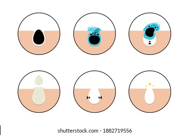 Cosmetics skin care, Process of using a facial cleanser to clean clogged pores and use of skin care creams to tighten pores