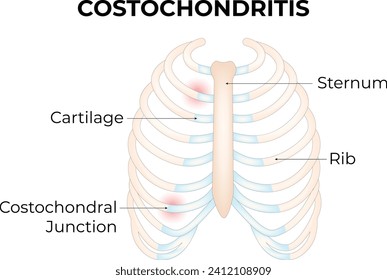 Costochondritis Science Design Vector Illustration