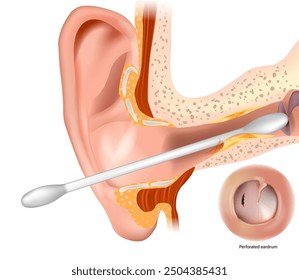 Cotton swabs  a major cause of eardrum perforations. Risks of Using Cotton Buds for Ear Cleaning. Burst or perforated eardrum 