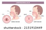 cough stridor wheeze rhonchi sound baby newborn upper vocal cord folds lung stop breathe Noisy birth larynx throat obstruction reflux delay inhales sleep apnea omega voice box floppy block arytenoid