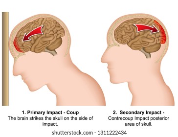 Coup - contrecoup medical vector illustration on white background