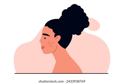 Couperose concept. Rosacea or superficial capillaries on woman face. Facial redness. Dermatology treatment and skincare. Isolated vector illustration in cartoon