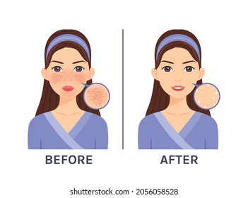 Couperose. Skin Disease, Problem on Beautiful Cartoon Female Face. Treatment of Rosacea. Red Unhealthy skin. Zoom. Before, After. White background. Illustration for Beauty, Medical Design. Vector