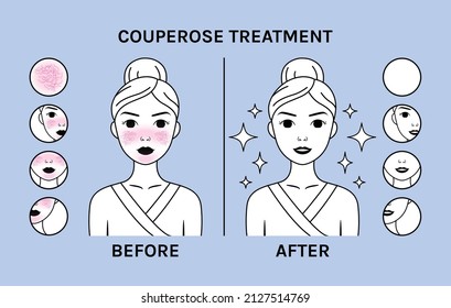 Couperose Treatment. Beautiful Woman with Rosacea on Face. Icons. Closeup. Before and After. Clean Face and Happy Young Girl. Flat Cartoon Line style. Vector illustration for Beauty and Medical design