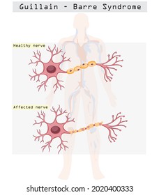 Covid 19 vaccine may have effect on Guillain-Barré syndrome (GBS). 