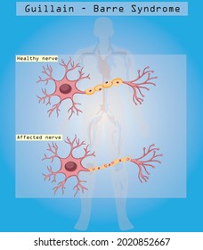 Covid 19 Vaccine May Have Effect On Guillain-Barré Syndrome (GBS). 