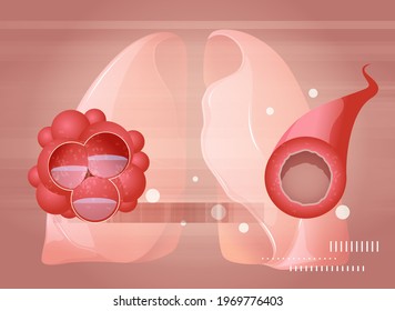 Covid-19 Impact on Human Lungs - PULMONARY EDEMA and Inflamed Airway  - Illustration as EPS 10 File