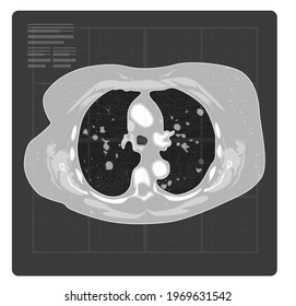 Covid-19 Testing - Human Lungs CT Scan - Illustration as EPS 10 File