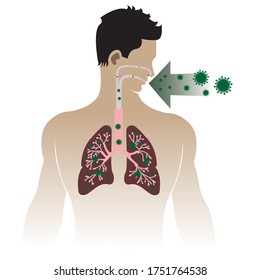 Covid-19,Corona virus Human body with lungs affected by virus cells through the respiratory tract by airborne droplets.virus damage lung, pulmonary.Vector illustration in white background