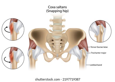 Coxa Saltans o Síndrome de Hip Snapping Hip también conocido como cadera danzante. Trochanter mayor, Tensor fasciae latae y Liotibial banda