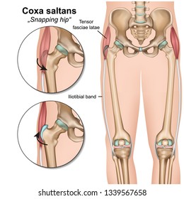 coxa saltans syndrome 3d medical vector illustration on white background