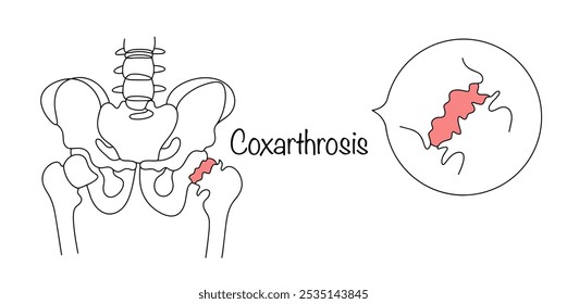 Coxartrosis. Desgaste progresivo y destrucción del tejido del cartílago de la articulación de la cadera. Una pelvis humana dibujada con una articulación saludable de la cadera en un lado y coxartrosis en el otro.