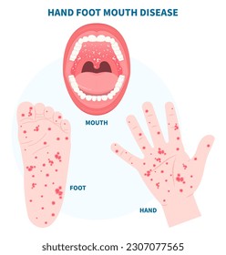 Coxsackie virus infection in mouth throat disease with Herpangina hand foot herpes strep stomatitis canker sore a enteroviruses