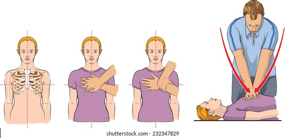 CPR demonstration (first aid).