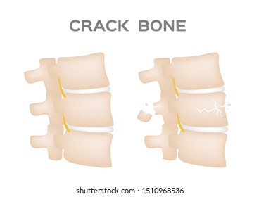 crack bone spine / broken and damaged disc vector