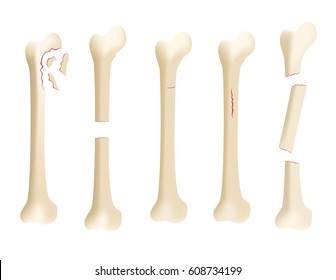 Crack Human Bone Vector