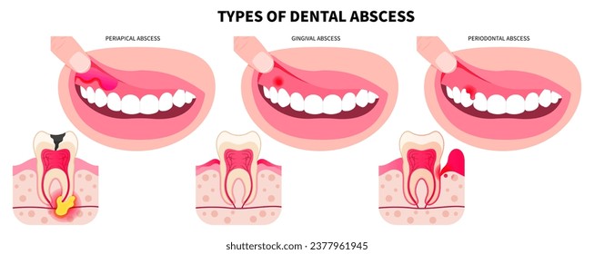 Cracked and broken wisdom teeth Cavities the swollen pain of oral cavity in bad breath hygiene health