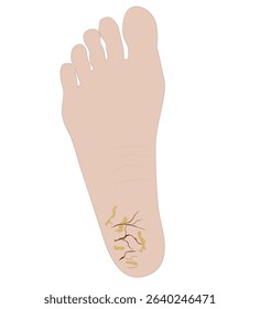 cracked feet. cracked heels and a medicine apply on it 