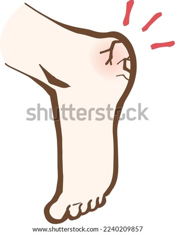 Cracked heel Dry heel Illustration
