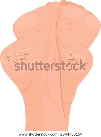 Cracked heels dry skin, Moisturizing foot, flat vector illustration. dry hard cracked heel. Foot skin care.