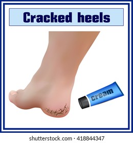 Cracked heels. Foot diseases.