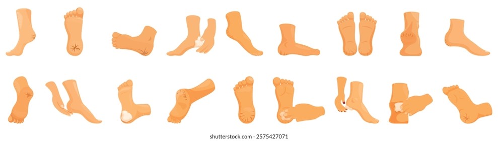 Cracked heels icons set. Feet in different positions, applying cream or suffering from dry skin, blisters and calluses