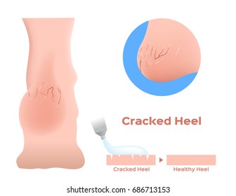 Cracked Heels And A Medicine Apply On It . Vector