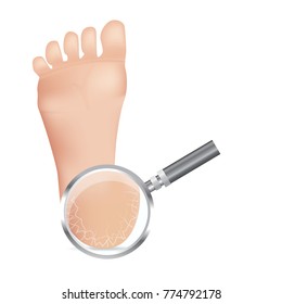 Cracked heels on white background Vector illustration.