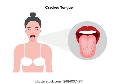 Cracked tongue problem and disease in human