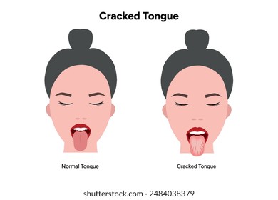 Problema de lengua agrietada en la lengua humana y normal