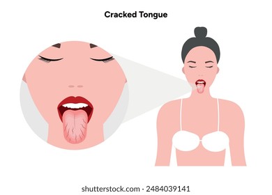 Cracked tongue problem and woman illustration 