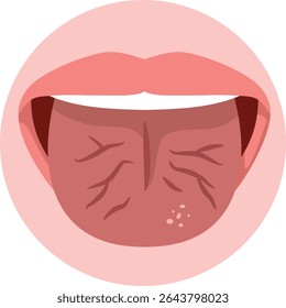 
Cracked Tongue Suffering from Medical Condition Vector Illustration. Person who is dehydrated or suffers from a disease that causes cracks in the mouth
