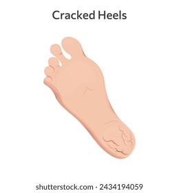 Cracks on feet vector illustration design. Dry and rough skin on heel, slough and calluses.