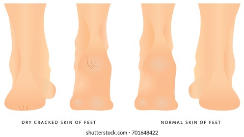 Cracks on Heels. Female legs with cracks. Concept of foot fungus with cracked heel. Groomed dry skin on feet and heels. 