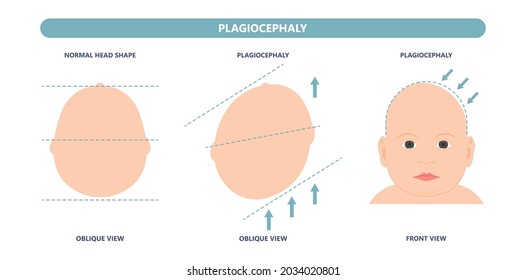 Plagiocephaly-Kopfumfang des Säuglings